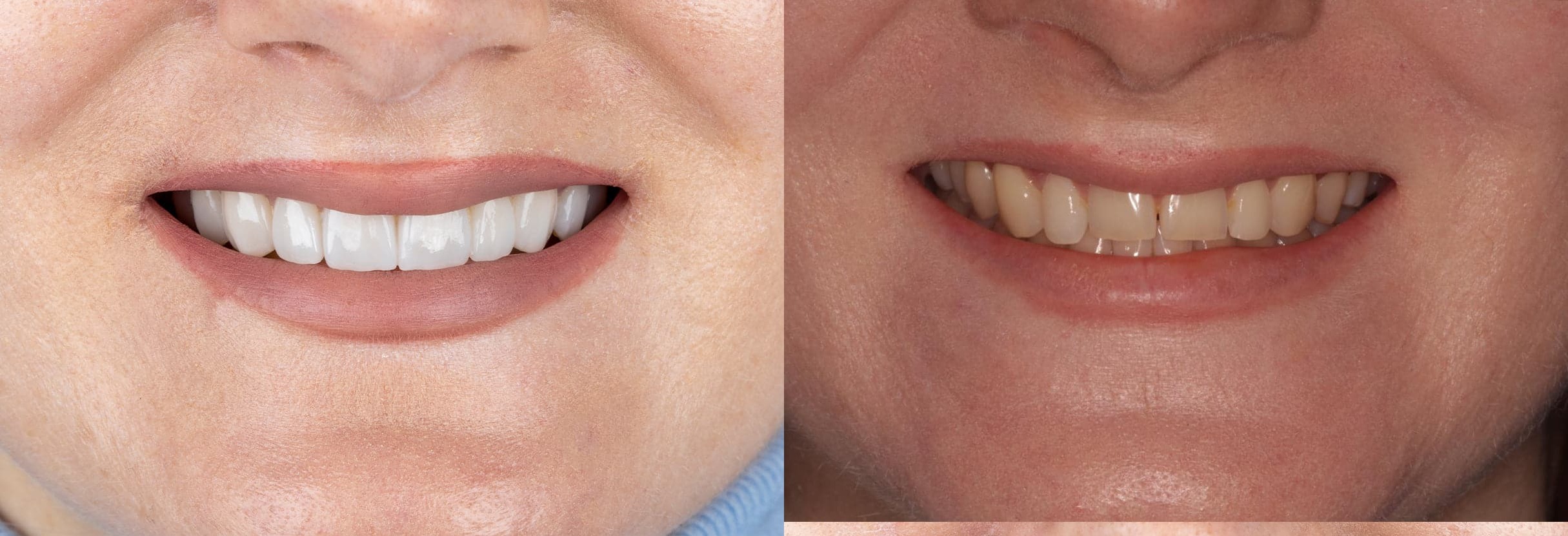 قبل وبعد العلاج — نتائج تجميل الأسنان في عيادة د. منصور